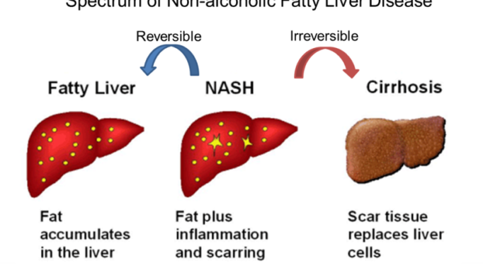 Non-invasive Quantification of Fatty Liver Disease – GoBio